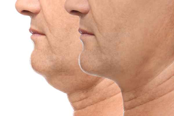 HIFU - Breakthrough in Anti - ageing 2 hifu results Melton Mowbray