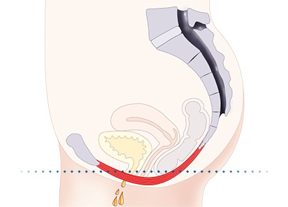 Pelvic-Floor Muscle Repair 5 Pelvic floor muscles Melton Mowbray