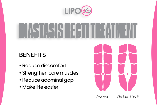 Revolutionising Muscle Repair: The Power of LIPO360 Body Sculpt Post-Injury 5 diastasis recti treatment Melton Mowbray