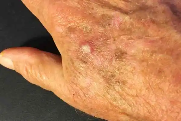 Cryopen For Actinic Keratoses 1 Image of Actinic keratoses Melton Mowbray on a person hand