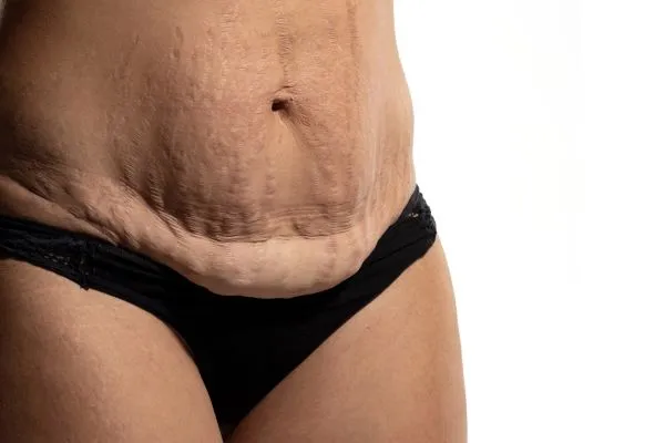 The science behind skin tightening Melton Mowbray picture of a woman's sagging skin on the stomach